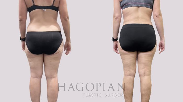 Before & After Liposuction Case 113 Back View in Atlanta, GA