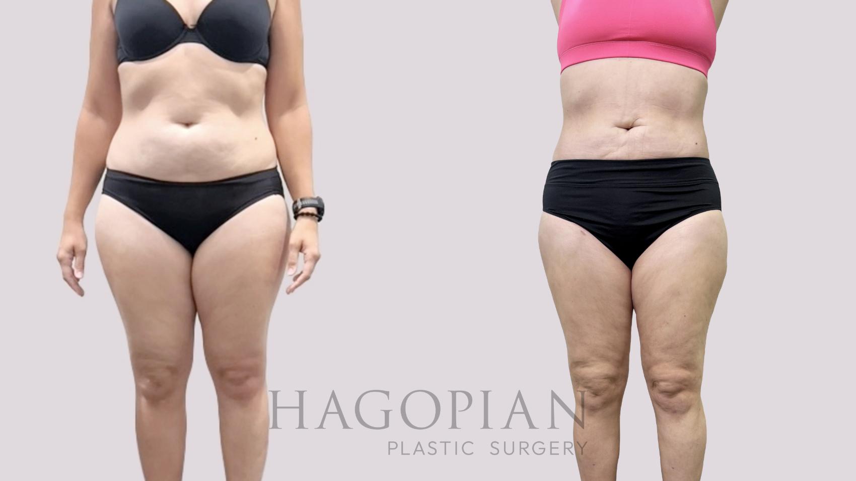 Before & After Liposuction Case 113 Front View in Atlanta, GA