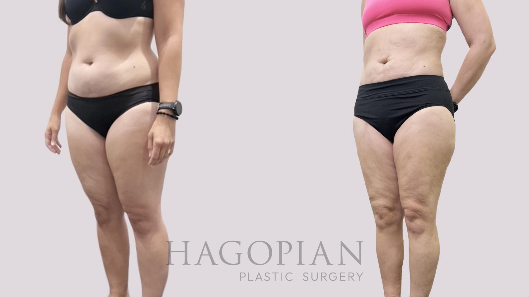Before & After Liposuction Case 113 Left Oblique View in Atlanta, GA