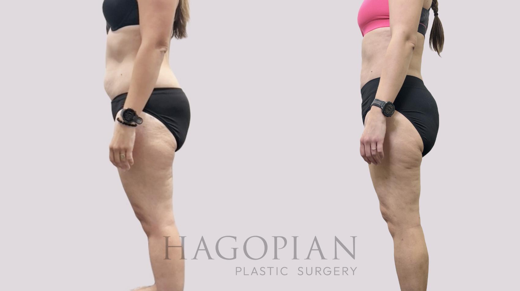 Before & After Liposuction Case 113 Left Side View in Atlanta, GA