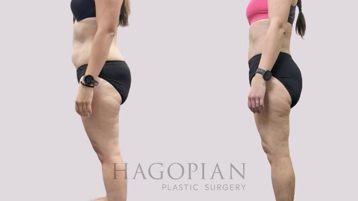 Before & After Liposuction Case 113 Left Side View in Atlanta, GA