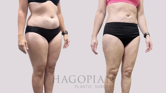Before & After Liposuction Case 113 Right Oblique View in Atlanta, GA