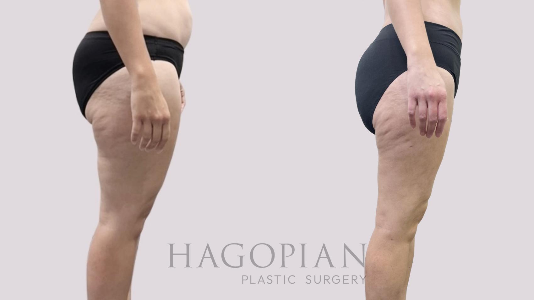 Before & After Liposuction Case 113 Right Side View in Atlanta, GA