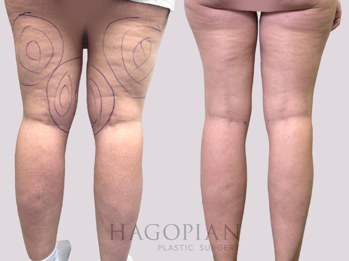 Before & After Liposuction Case 144 Back View in Atlanta, GA