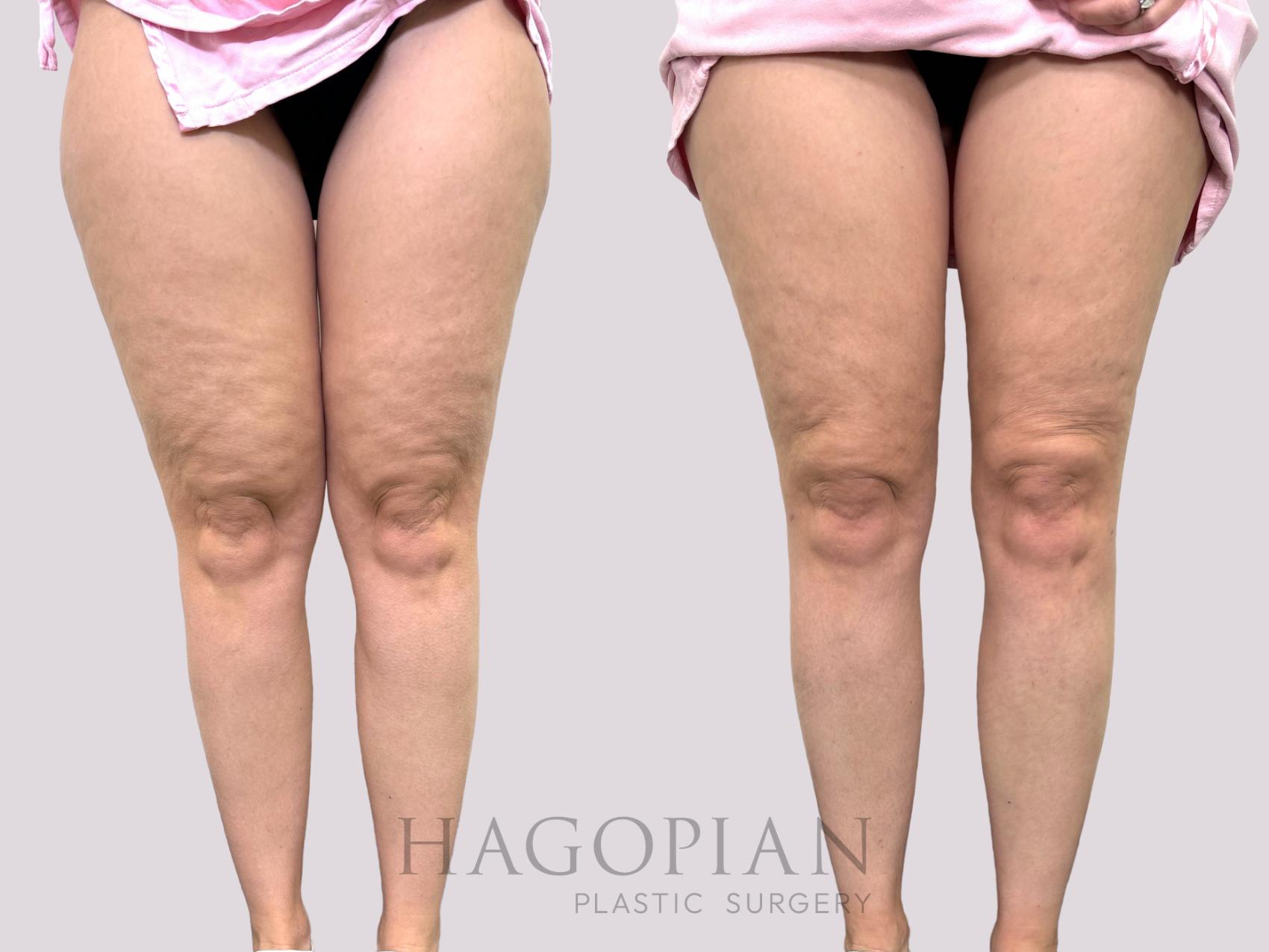 Before & After Liposuction Case 144 Front View in Atlanta, GA