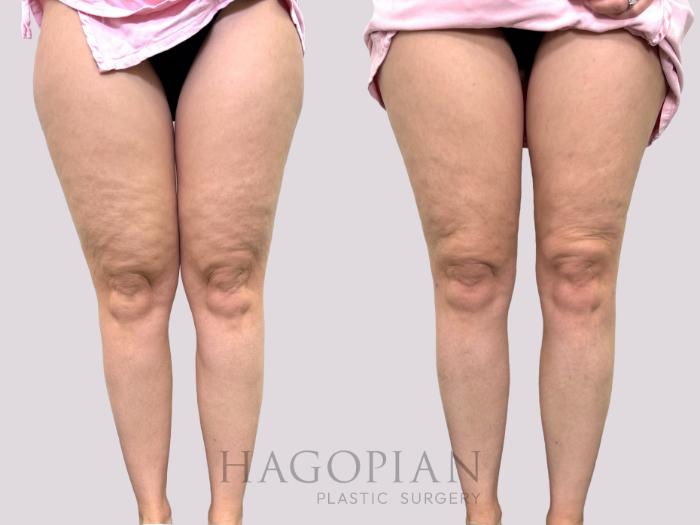 Before & After Liposuction Case 144 Front View in Atlanta, GA