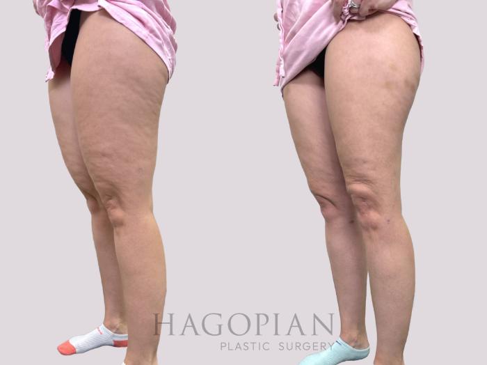 Before & After Liposuction Case 144 Left Oblique View in Atlanta, GA