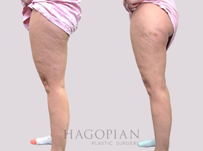 Before & After Liposuction Case 144 Left Side View in Atlanta, GA