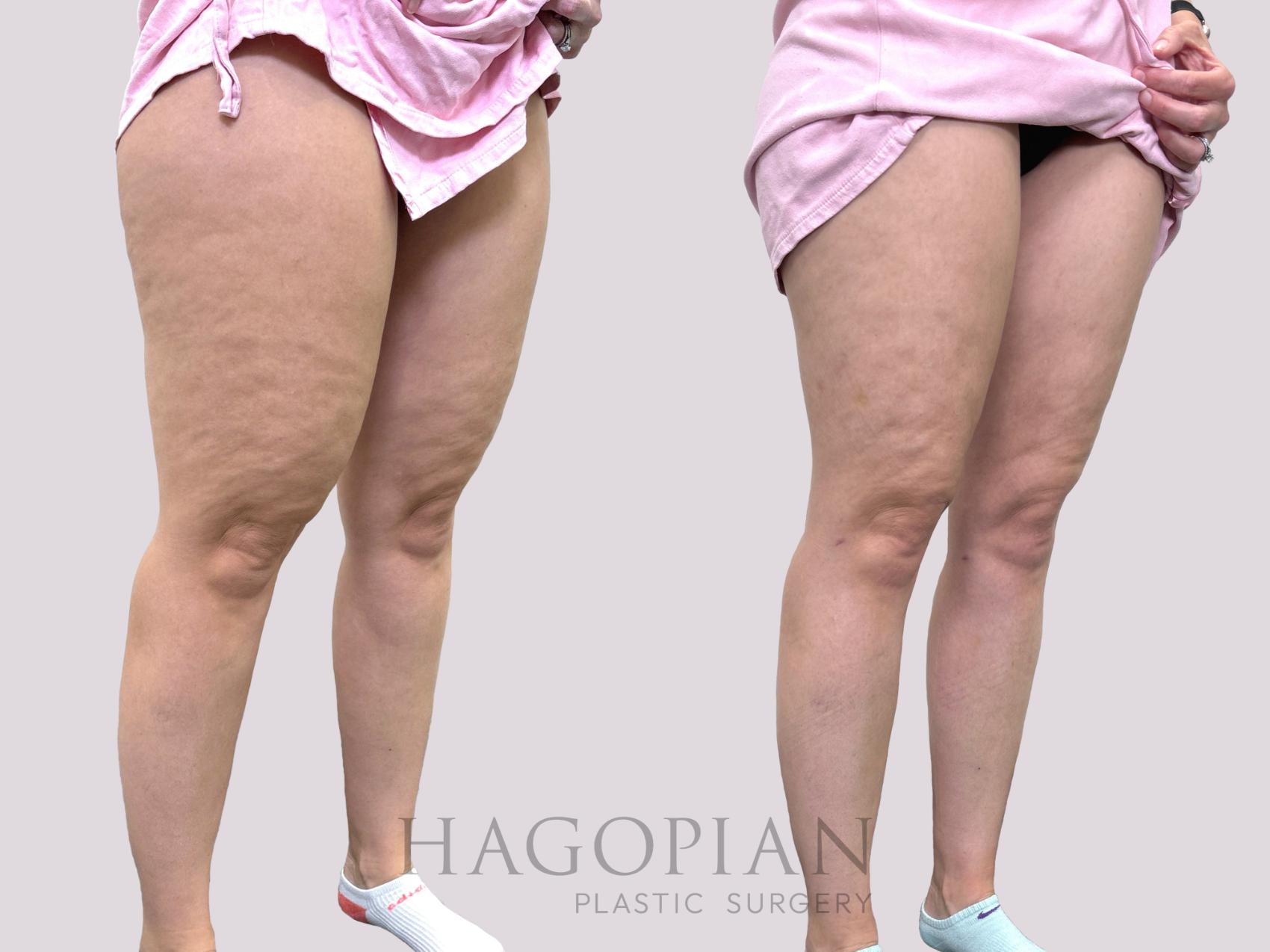 Before & After Liposuction Case 144 Right Oblique View in Atlanta, GA