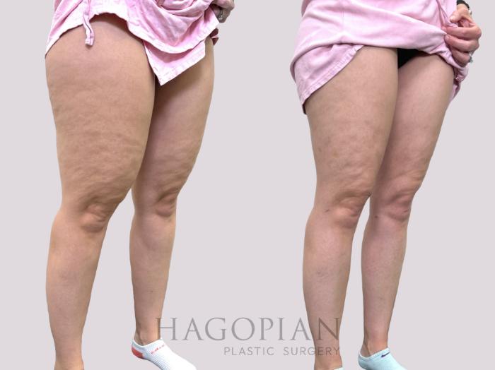 Before & After Liposuction Case 144 Right Oblique View in Atlanta, GA