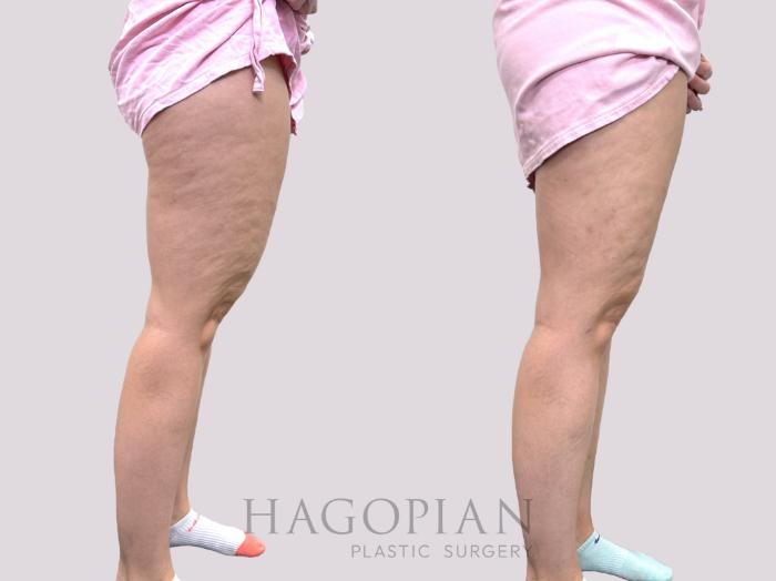 Before & After Liposuction Case 144 Right Side View in Atlanta, GA
