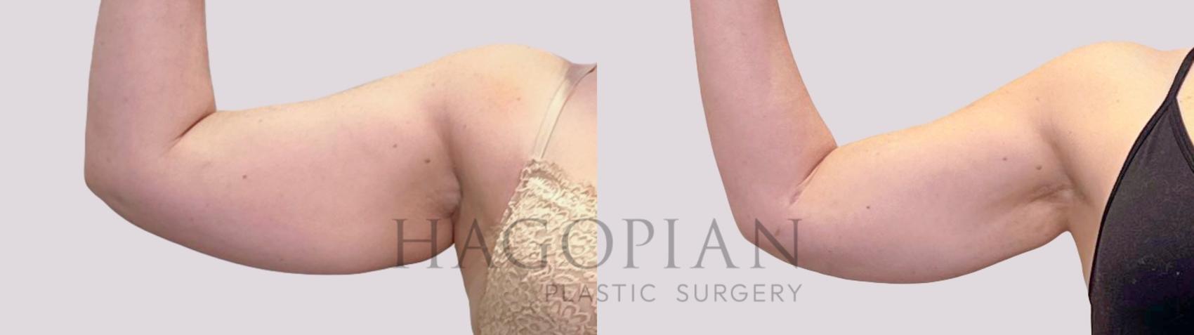 Before & After Liposuction Case 178 Front View in Atlanta, GA