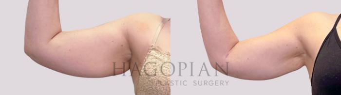 Before & After Liposuction Case 178 Front View in Atlanta, GA