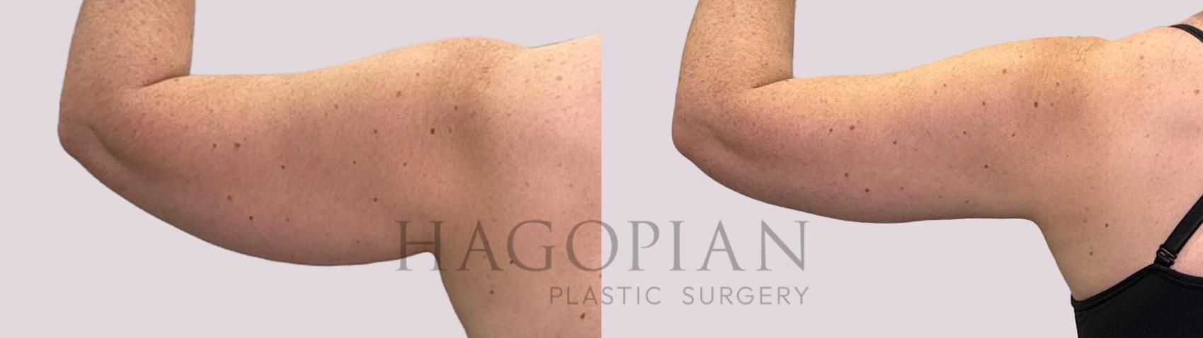 Before & After Liposuction Case 178 Left Side View in Atlanta, GA
