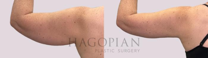 Before & After Liposuction Case 178 Left Side View in Atlanta, GA