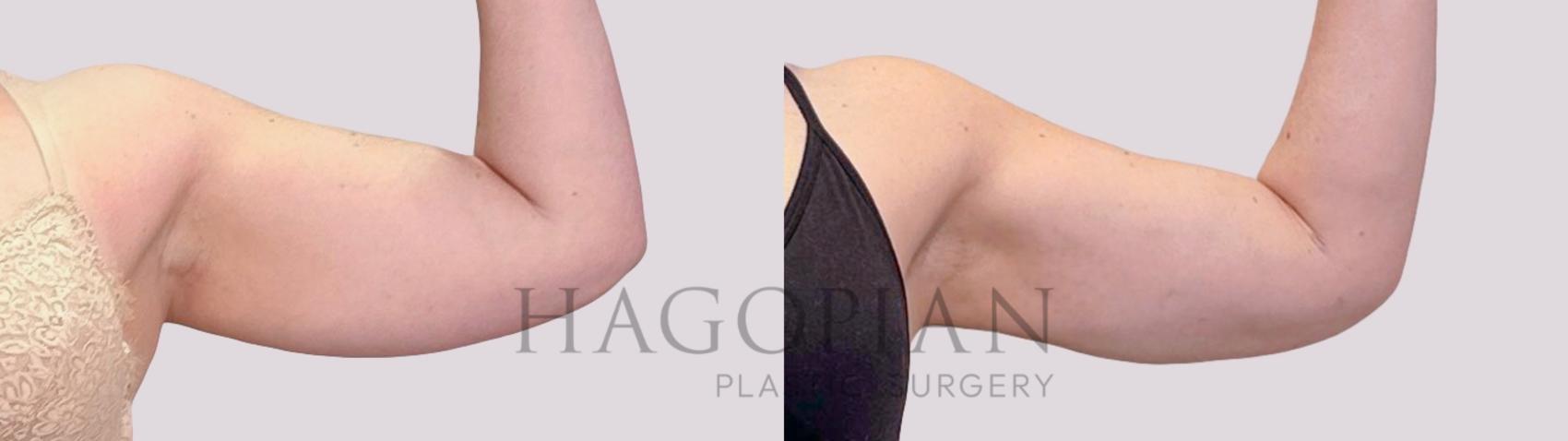 Before & After Liposuction Case 178 Right Side View in Atlanta, GA