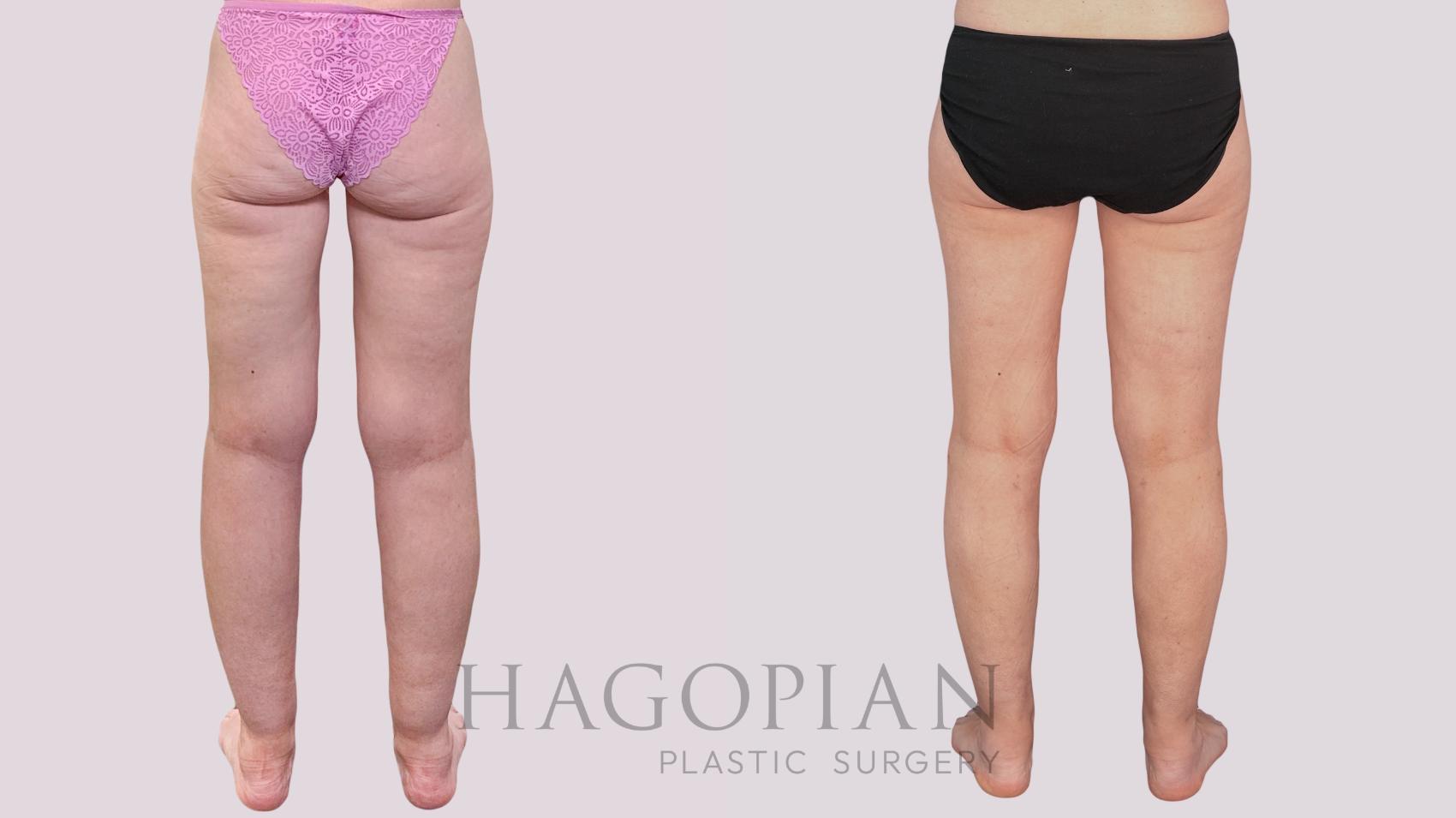 Before & After Liposuction Case 265 Back View in Atlanta, GA