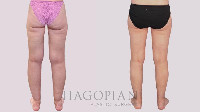 Before & After Liposuction Case 265 Back View in Atlanta, GA