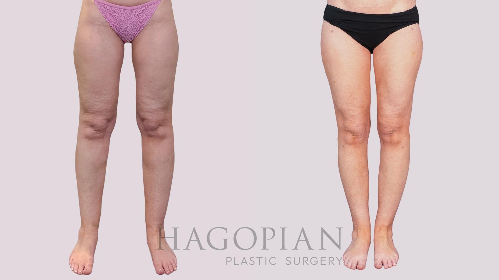 Before & After Liposuction Case 265 Front View in Atlanta, GA