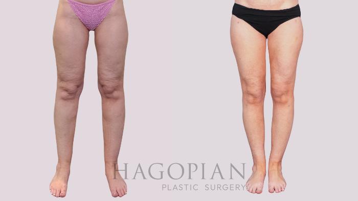 Before & After Liposuction Case 265 Front View in Atlanta, GA