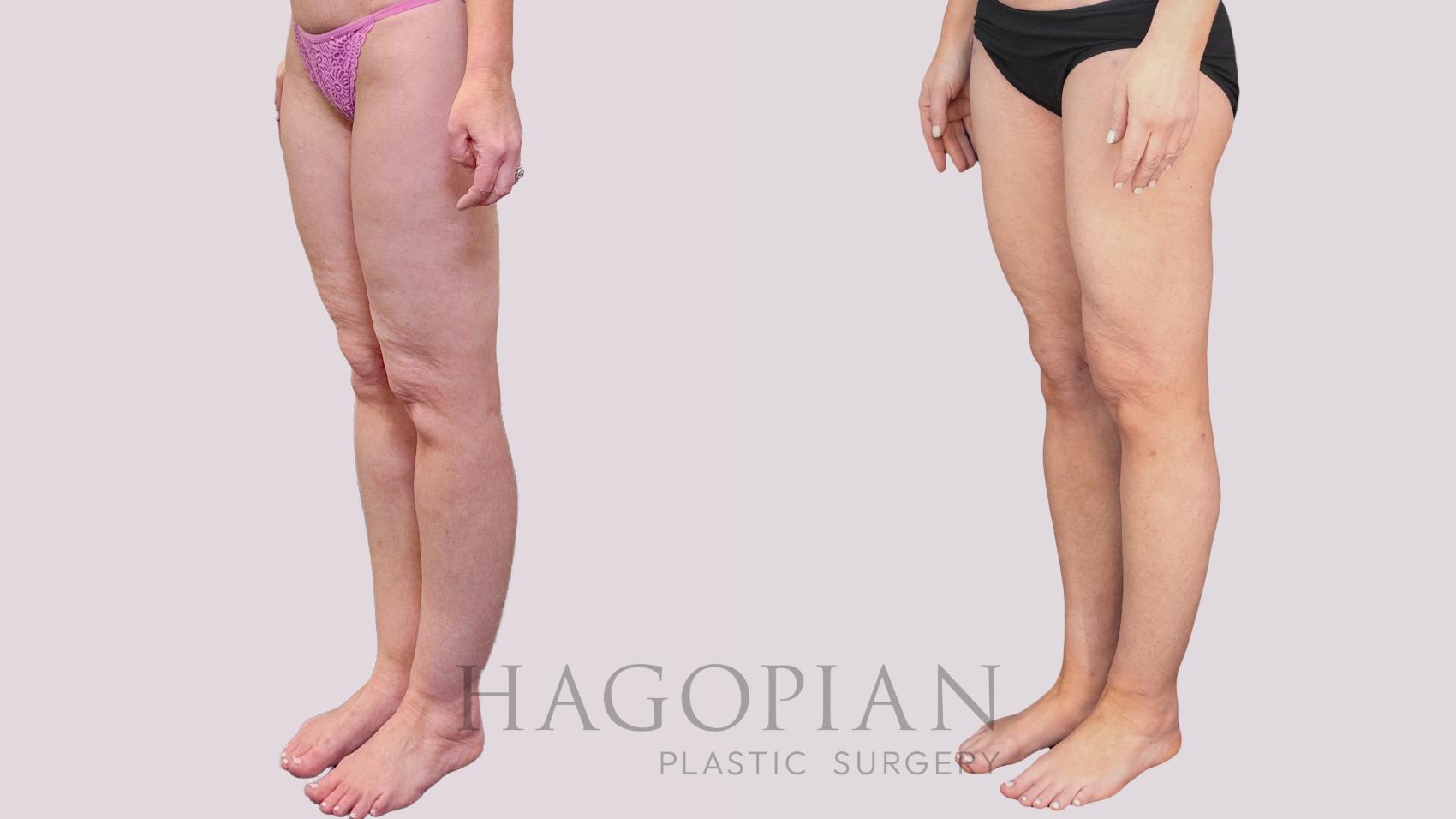Before & After Liposuction Case 265 Left Oblique View in Atlanta, GA