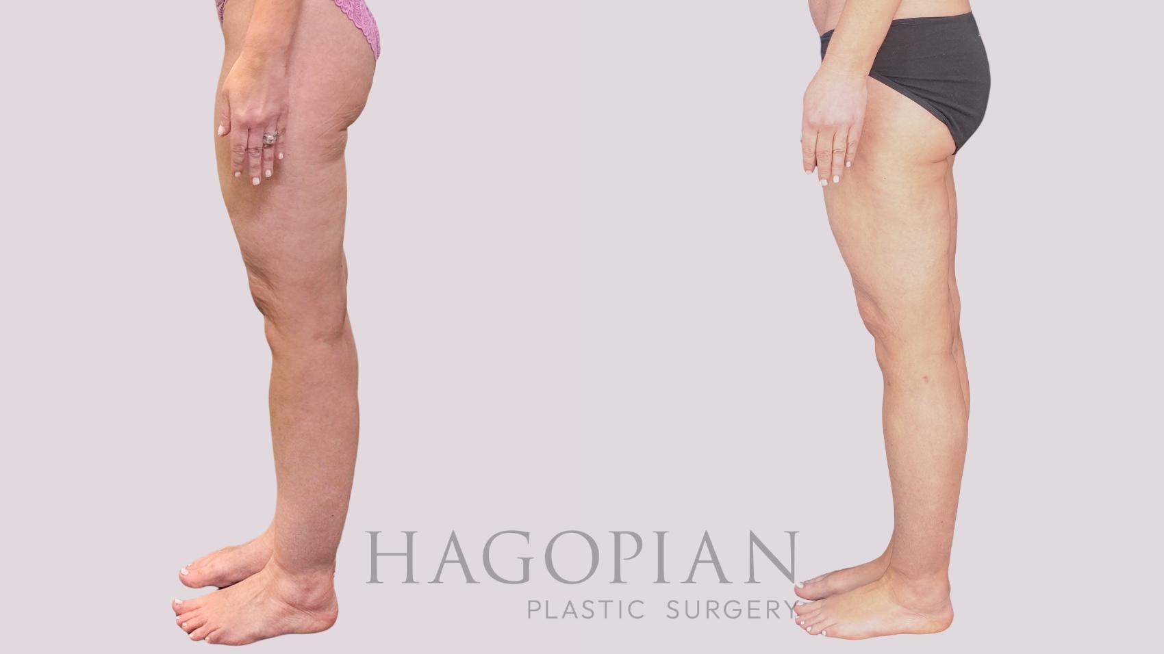 Before & After Liposuction Case 265 Left Side View in Atlanta, GA