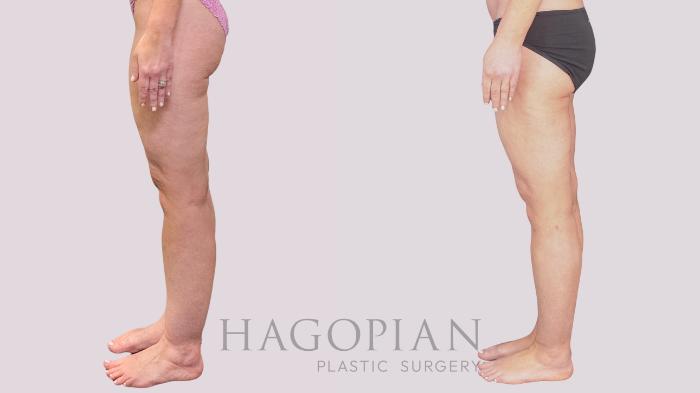 Before & After Liposuction Case 265 Left Side View in Atlanta, GA