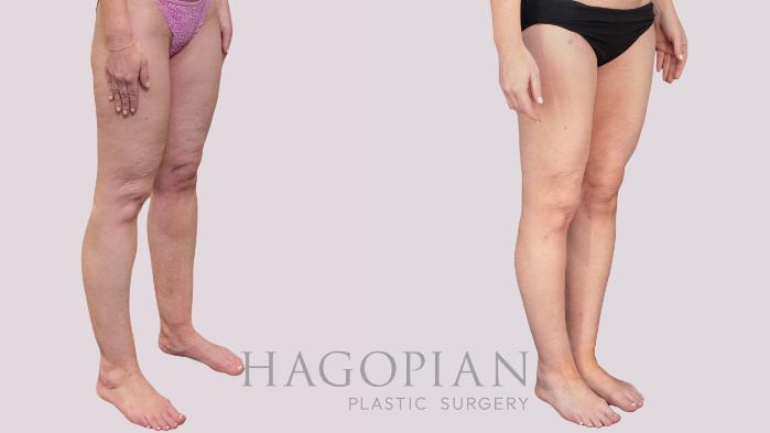 Before & After Liposuction Case 265 Right Oblique View in Atlanta, GA