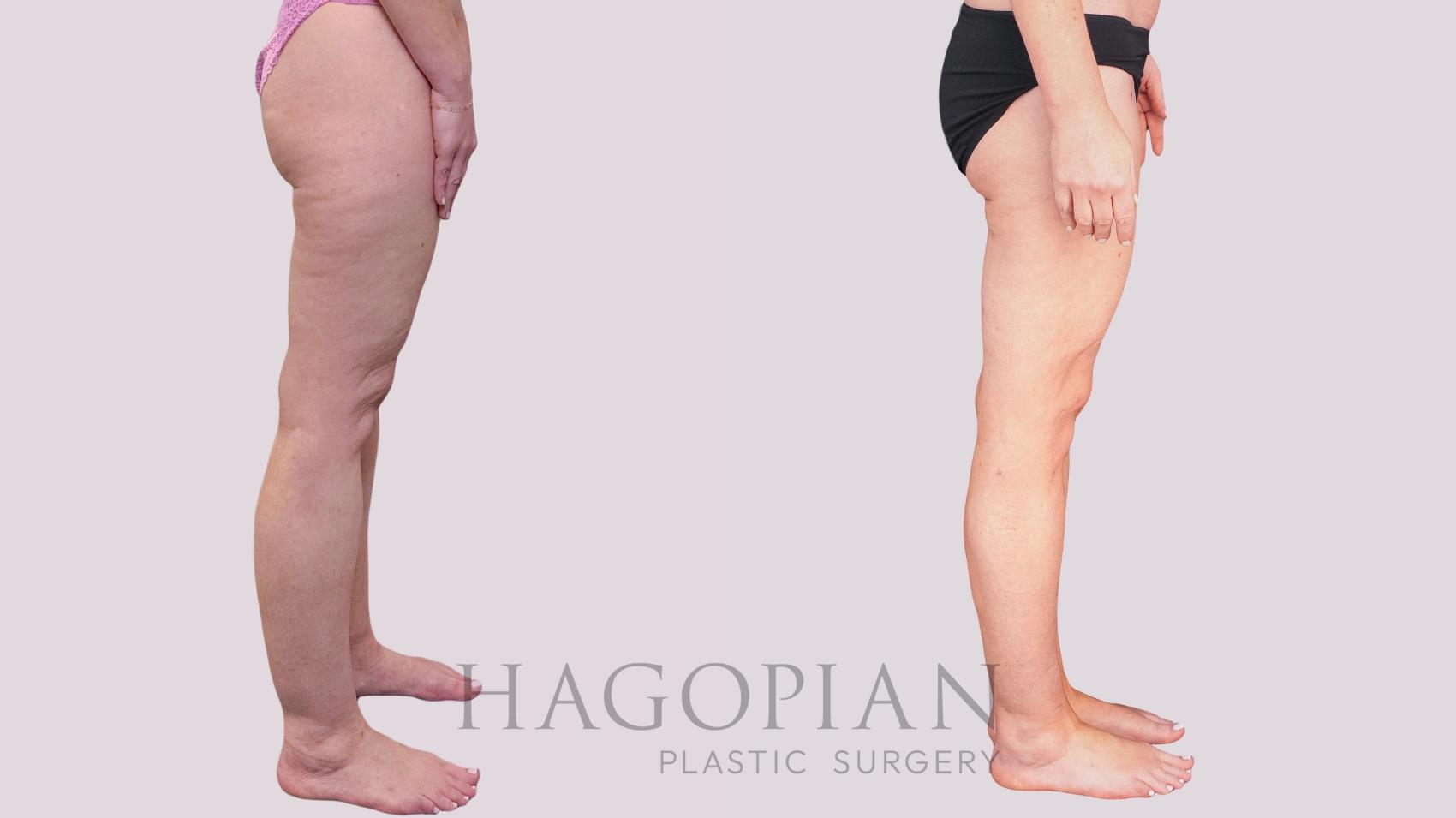 Before & After Liposuction Case 265 Right Side View in Atlanta, GA