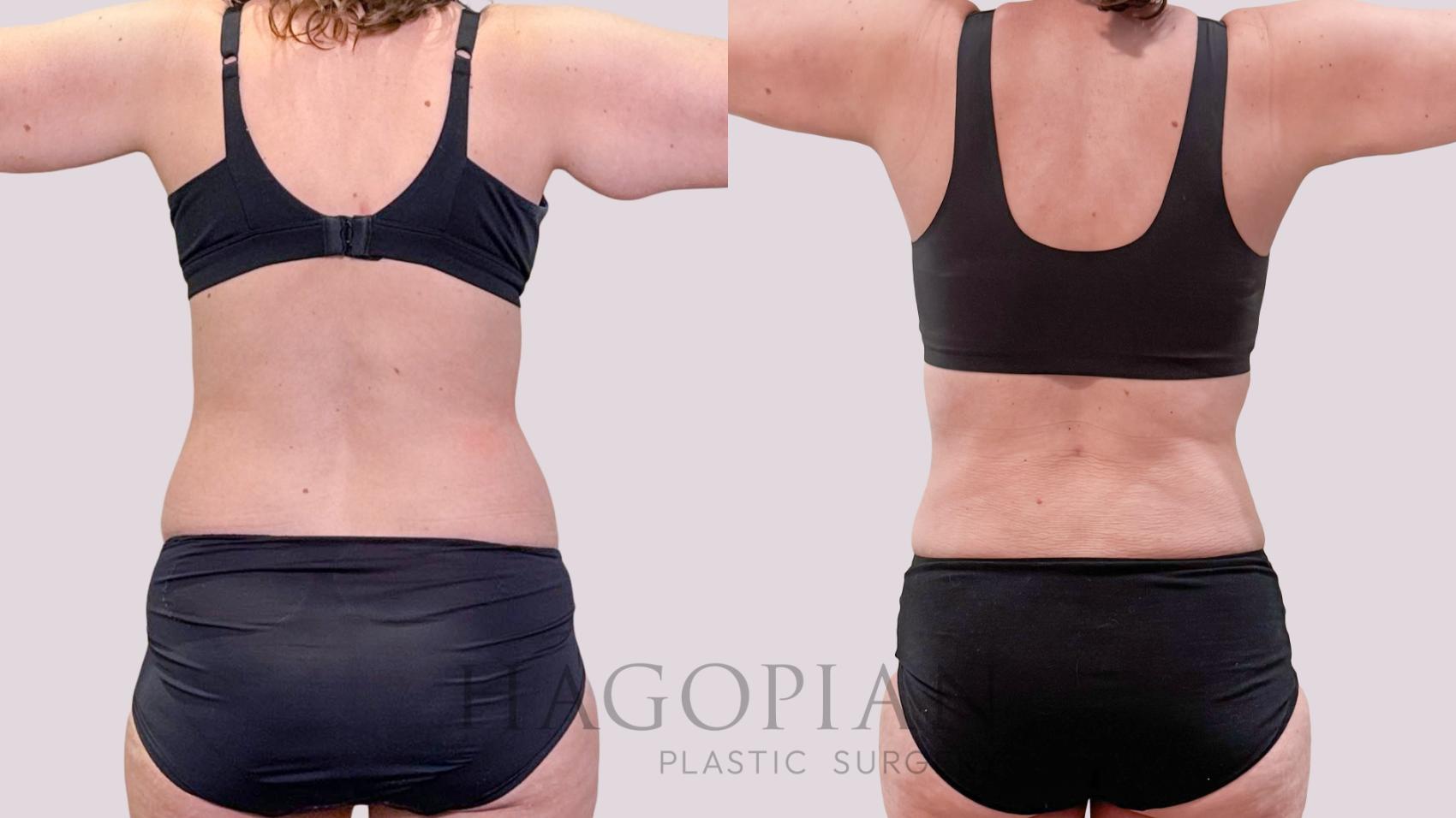 Before & After Liposuction Case 266 Back View in Atlanta, GA