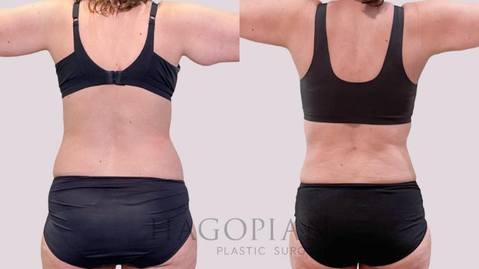 Before & After Liposuction Case 266 Back View in Atlanta, GA