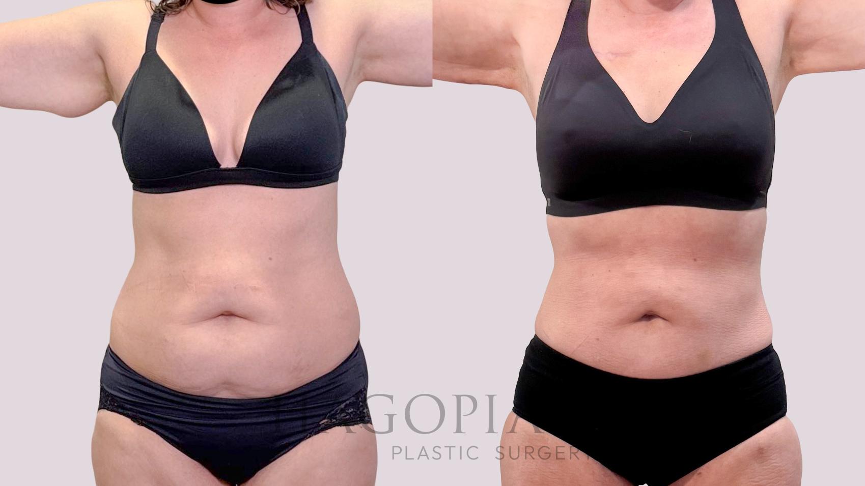 Before & After Liposuction Case 266 Front View in Atlanta, GA