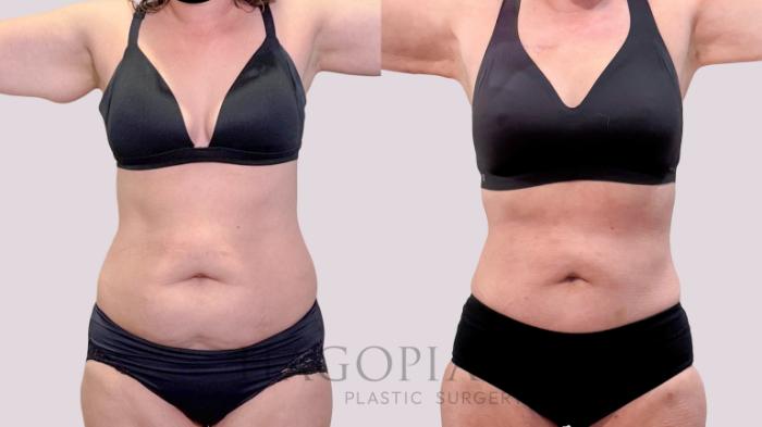 Before & After Liposuction Case 266 Front View in Atlanta, GA