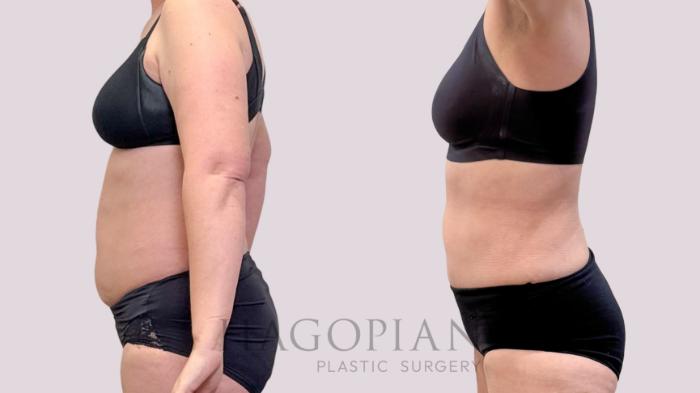 Before & After Liposuction Case 266 Left Side View in Atlanta, GA