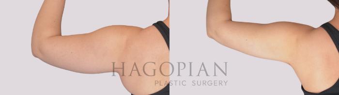 Before & After Liposuction Case 282 Back Left View in Atlanta, GA