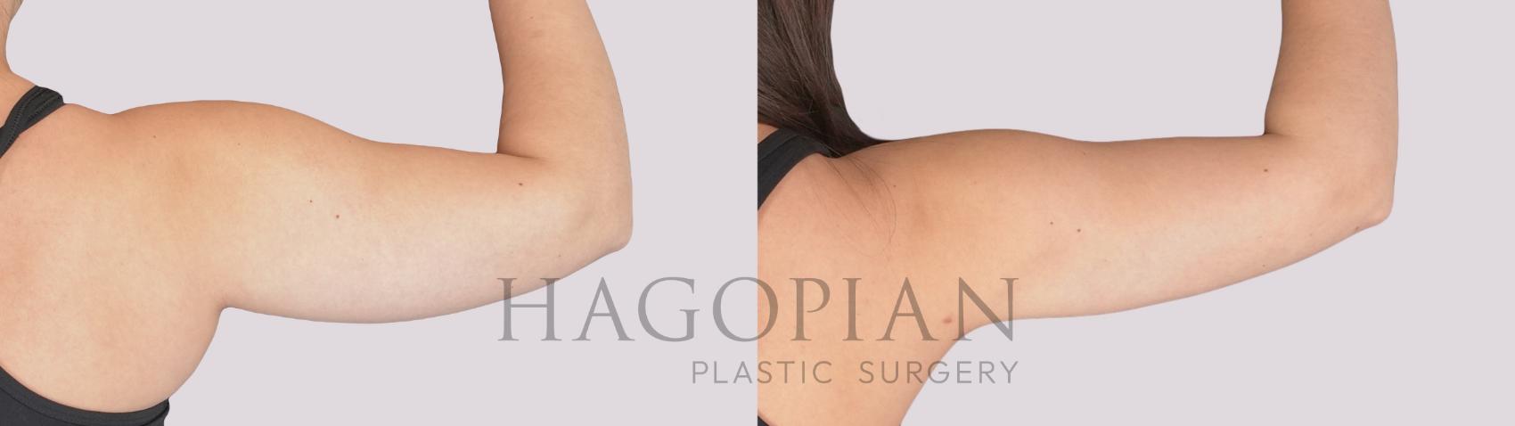 Before & After Liposuction Case 282 Back Right View in Atlanta, GA