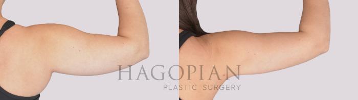 Before & After Liposuction Case 282 Back Right View in Atlanta, GA