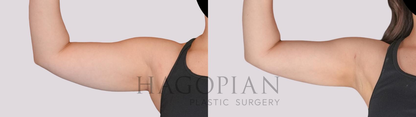 Before & After Liposuction Case 282 Front Left View in Atlanta, GA