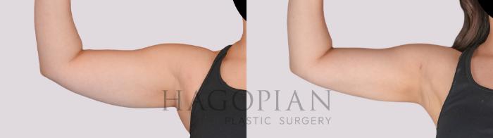 Before & After Liposuction Case 282 Front Left View in Atlanta, GA