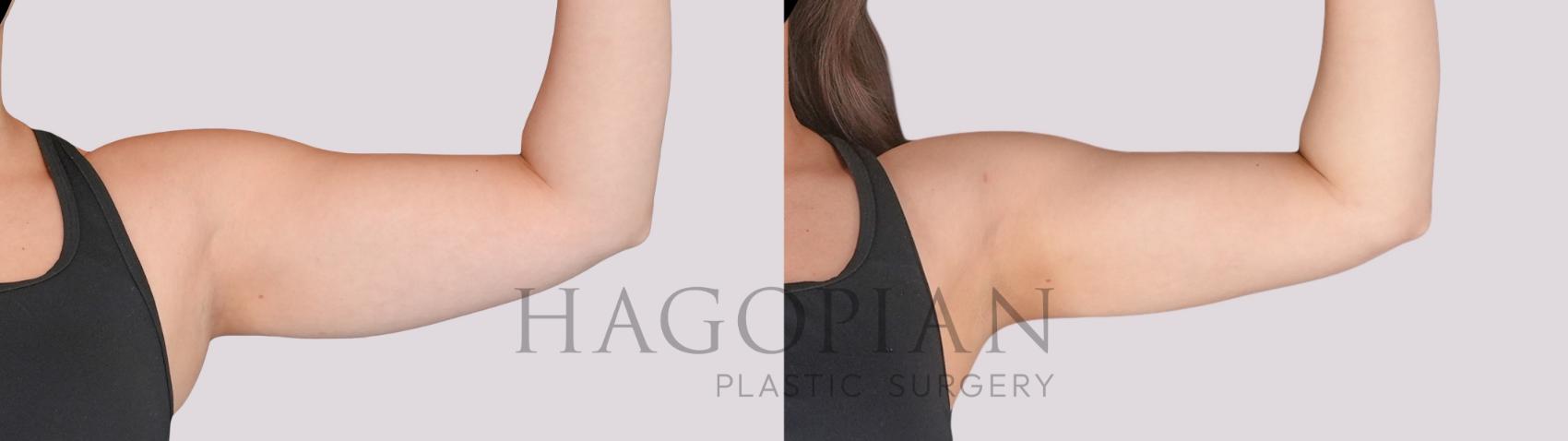 Before & After Liposuction Case 282 Front Right View in Atlanta, GA