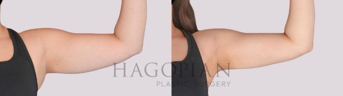 Before & After Liposuction Case 282 Front Right View in Atlanta, GA