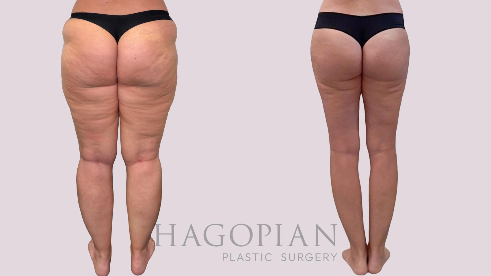 Before & After Liposuction Case 283 Back View in Atlanta, GA