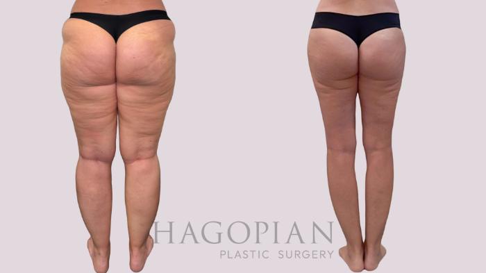 Before & After Liposuction Case 283 Back View in Atlanta, GA