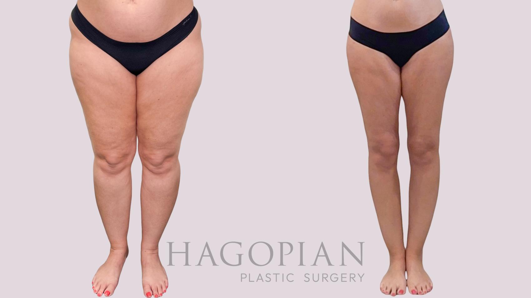 Before & After Liposuction Case 283 Front View in Atlanta, GA