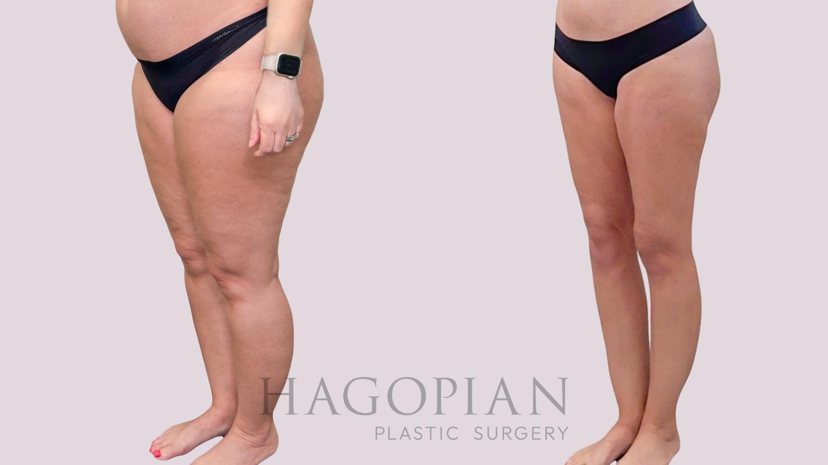 Before & After Liposuction Case 283 Left Oblique View in Atlanta, GA