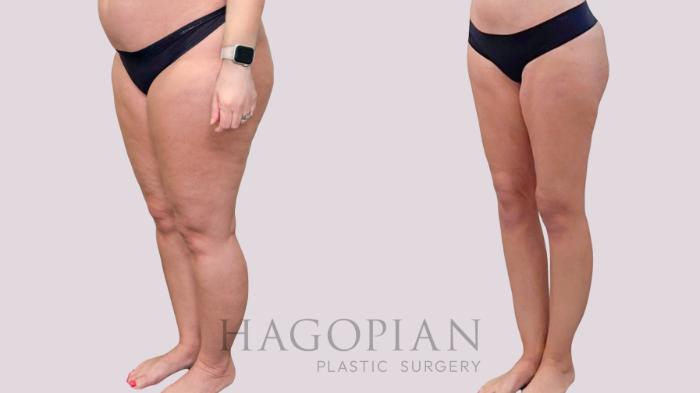 Before & After Liposuction Case 283 Left Oblique View in Atlanta, GA