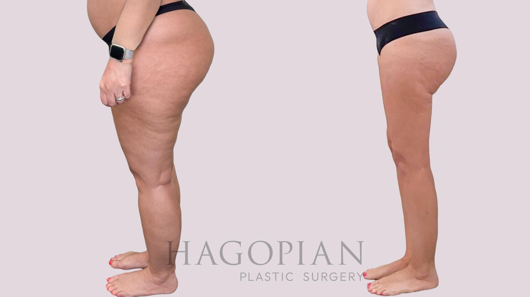 Before & After Liposuction Case 283 Left Side View in Atlanta, GA