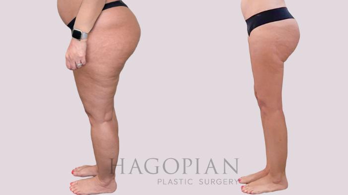 Before & After Liposuction Case 283 Left Side View in Atlanta, GA