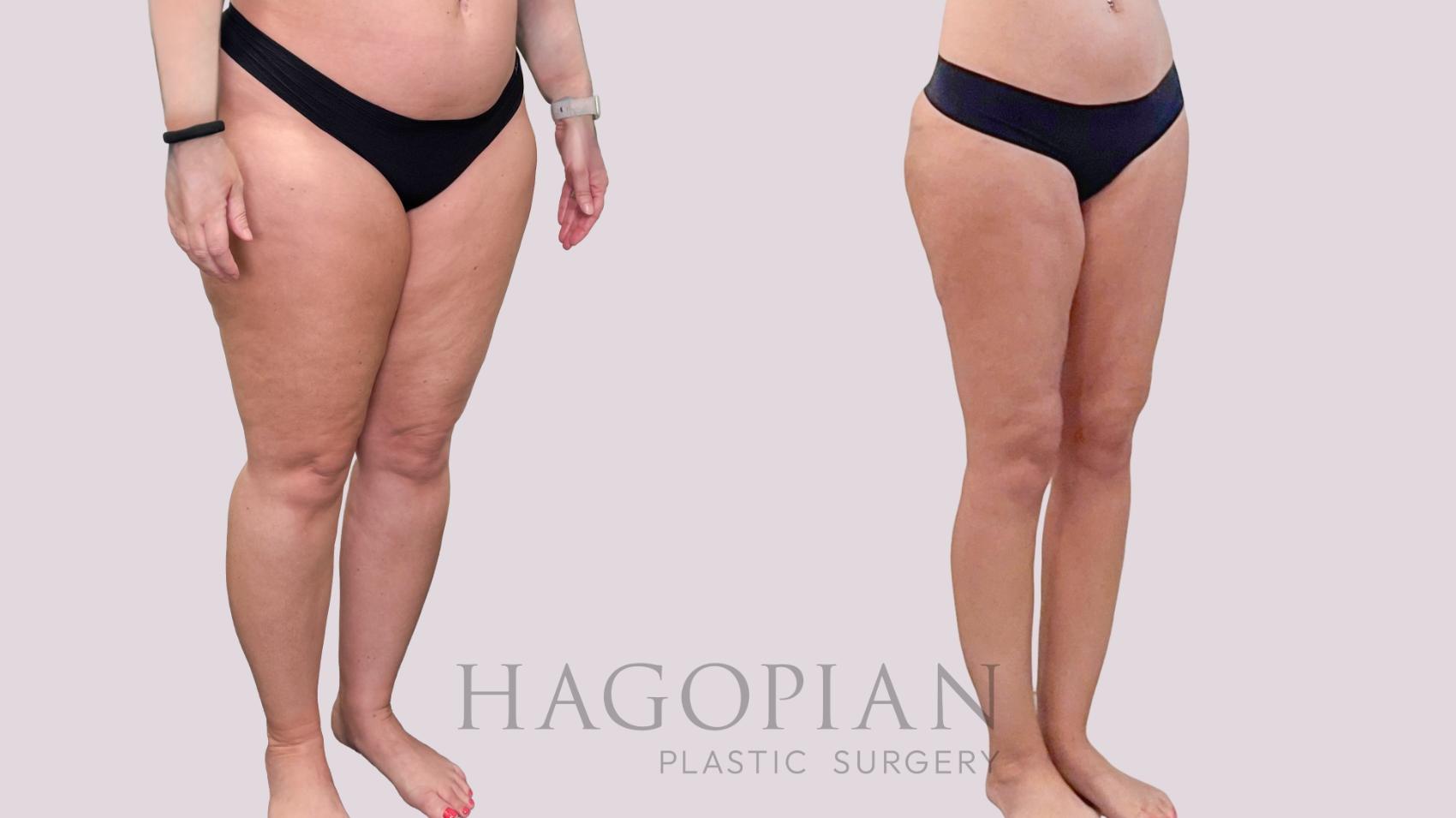 Before & After Liposuction Case 283 Right Oblique View in Atlanta, GA
