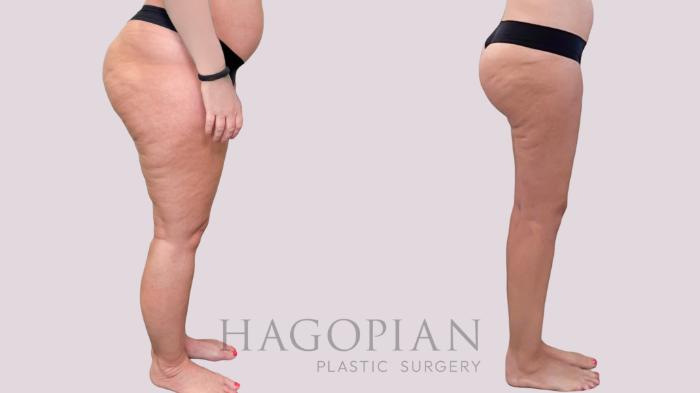 Before & After Liposuction Case 283 Right Side View in Atlanta, GA
